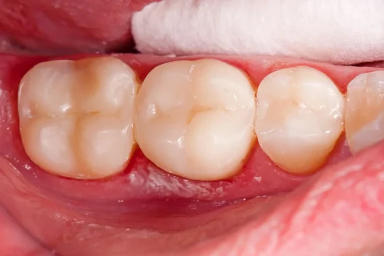 ใส่ครอบฟัน Dental Crown