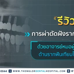 รีวิวผ่าตัดฝังรากฟันเทียมโดยทันตแพทย์ผู้เชี่ยวชาญด้านรากฟันเทียม