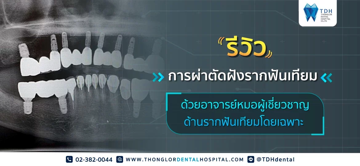 รีวิวผ่าตัดฝังรากฟันเทียมโดยทันตแพทย์ผู้เชี่ยวชาญด้านรากฟันเทียม