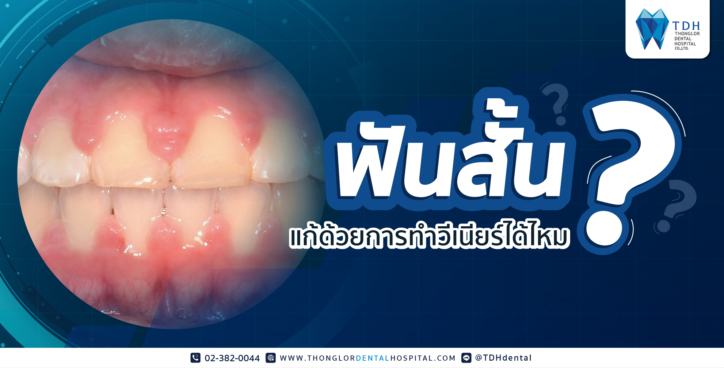 ฟันสั้นแก้ด้วยการทำวีเนียร์ได้ไหม? - TDH